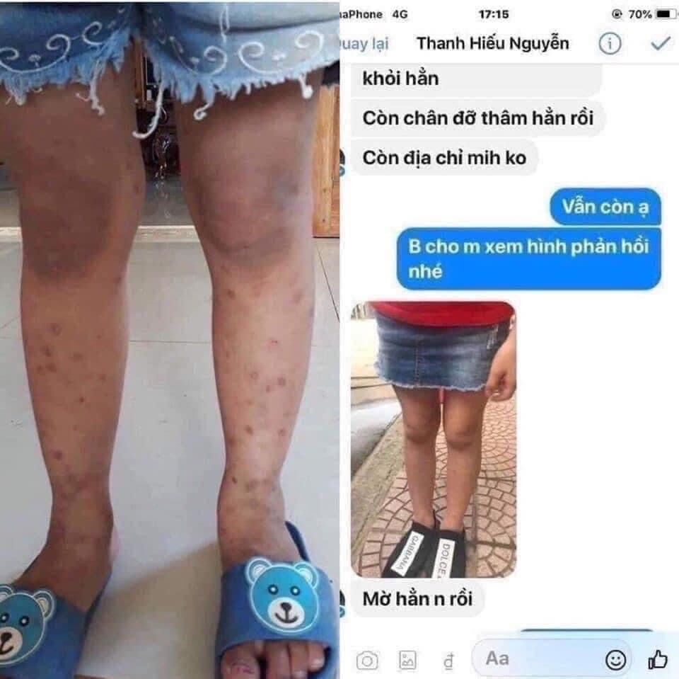 Kem bôi sẹo hiruscar kids thái lan