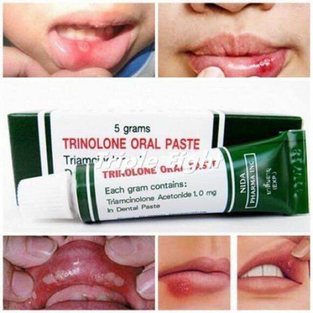 Kem nhiệt miệng , lỡ miệng Trinolone Oral Paste Thái Lan
