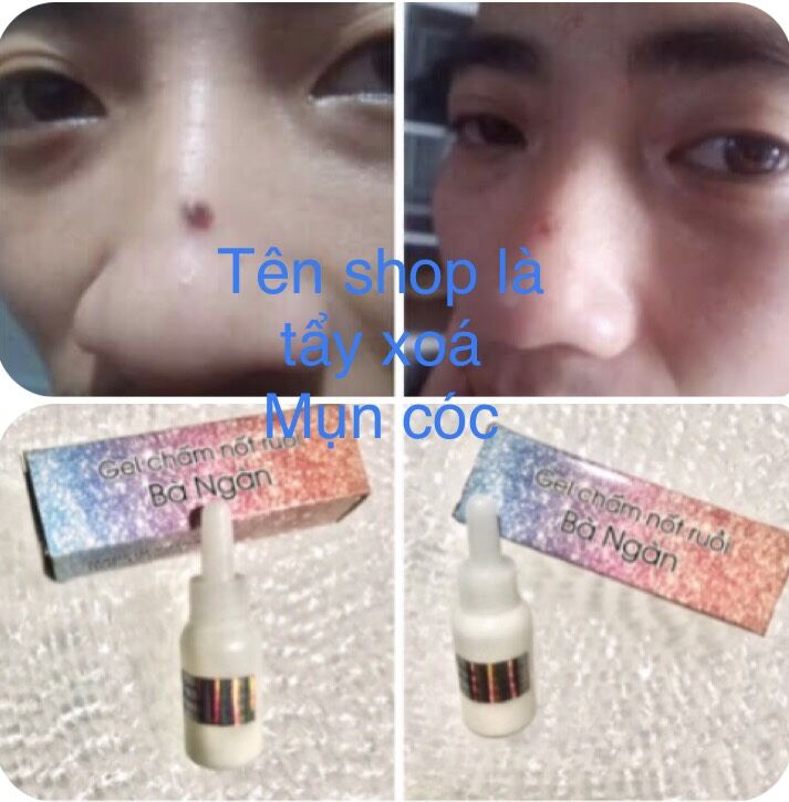 Tẩy xoá nốt ruồi ,mụn cóc,mụn thịt,tàn nhang
