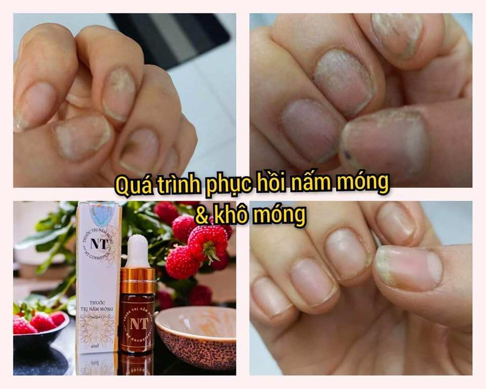 Combo serum nấm móng tay chân - Dưỡng cứng móng