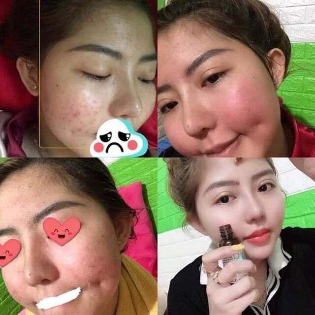 TÁI TẠO DA MỘC DƯƠNG CHÂU