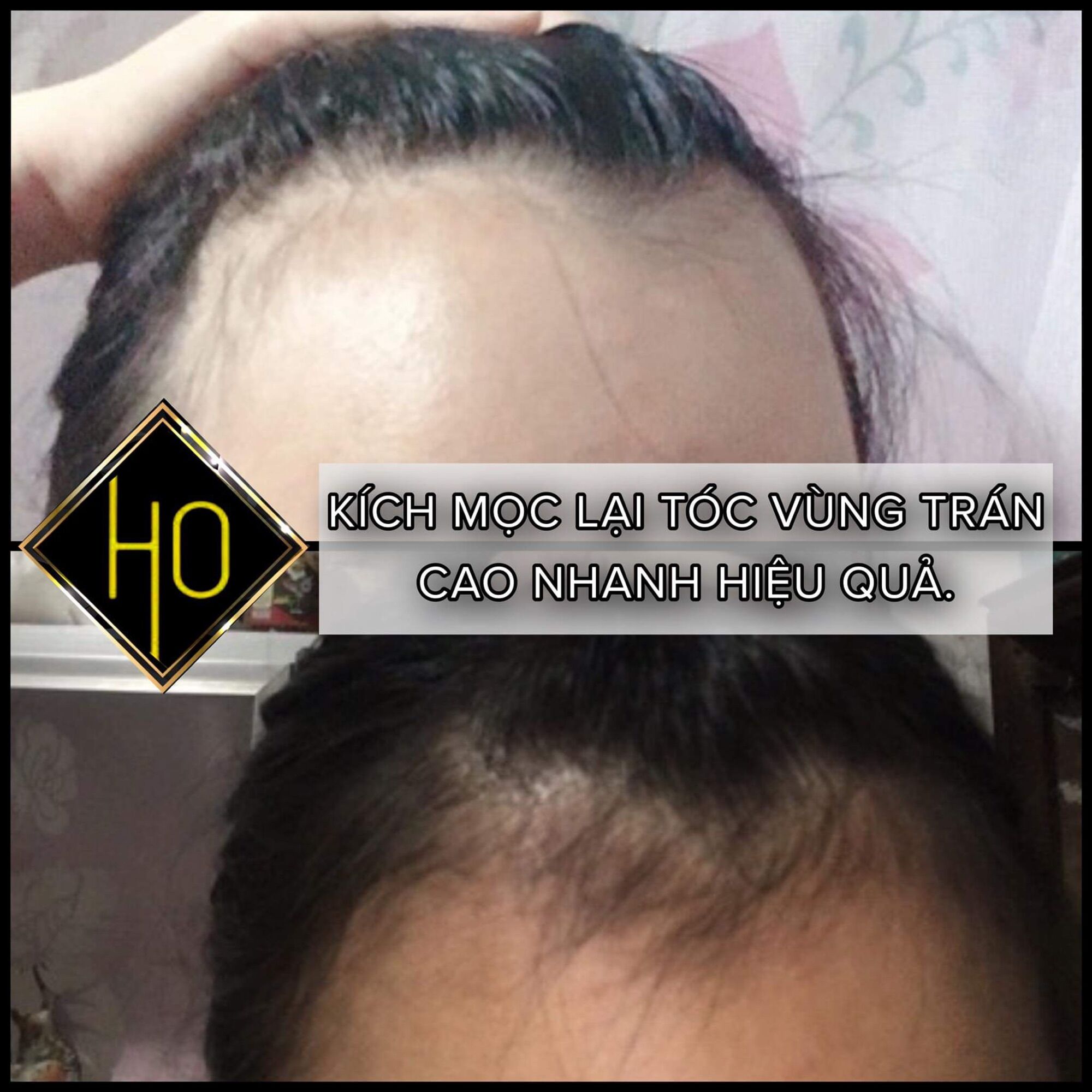 SẢN PHẨM MỌC TÓC NGUYỄN HỒ X3PLUS 18%