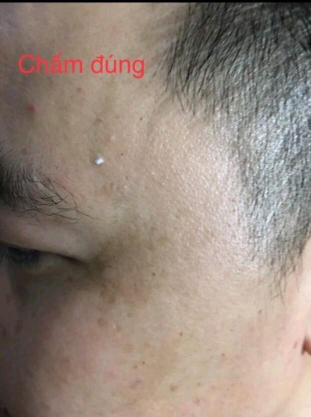 Tẩy xoá nốt ruồi ,mụn cóc,mụn thịt,tàn nhang