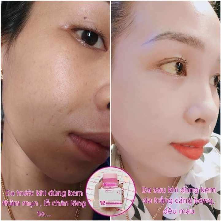 kem face trắng mịn da ngừa mụn Myo