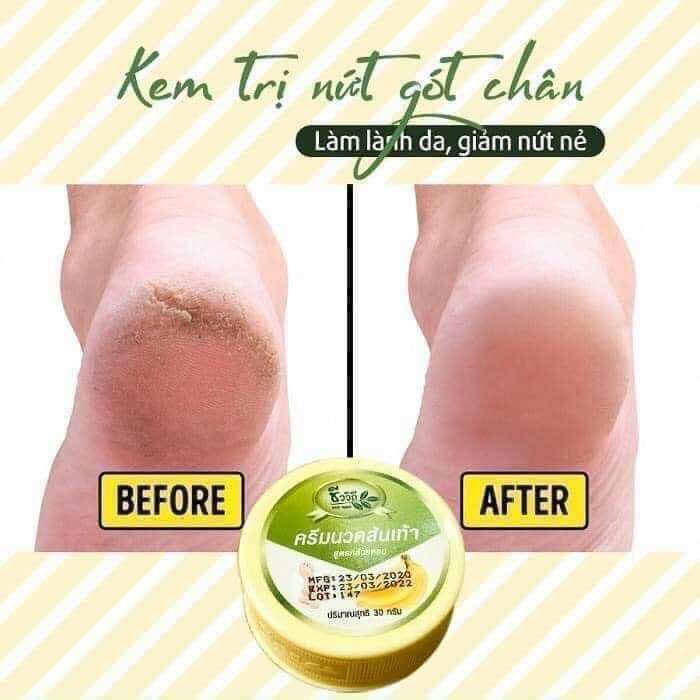 Kem bôi nứt gót chân Chuối Thái Lan