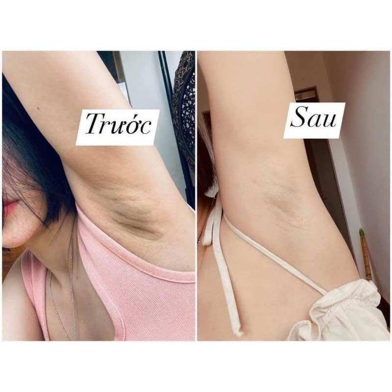 Kem Giảm Thâm Nách S88 Total White Thái Lan ( Che tên sp)