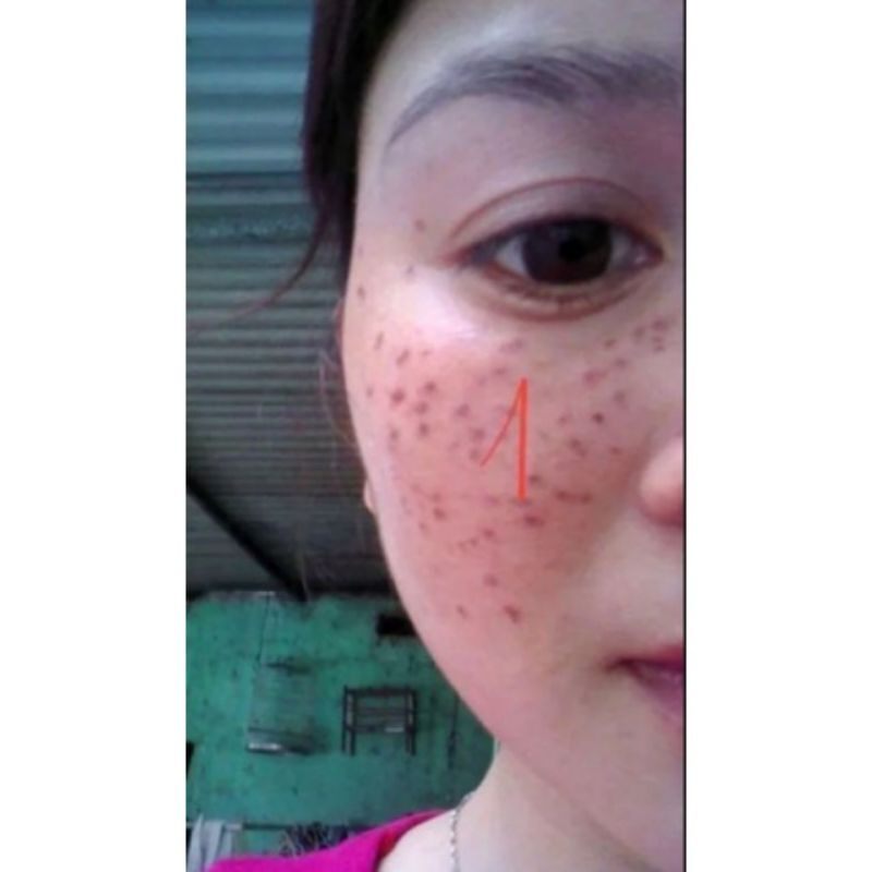 Chấm nám ,tàn nhang Đức Thịnh.