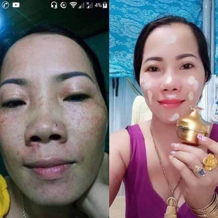 (CHÍNH HÃNG)KEM SÂM NCOLAGEN TẶNG SÉT TẨY TẾ BÀO
