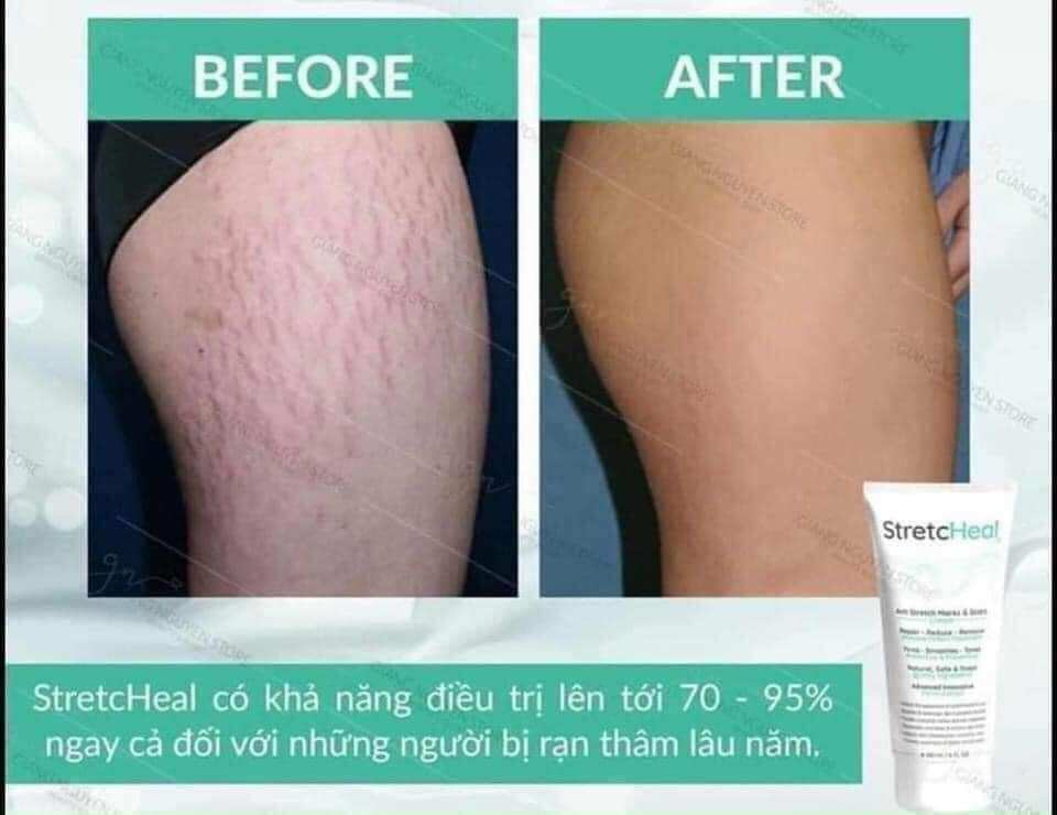 [HÀNG CTY] KEM XÓA RẠN DA Stretcheal CHO MẸ BẦU
