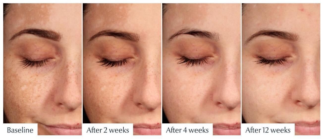 Serum giúp giảm thâm nám sau 2 tuần Eucerin 50ml