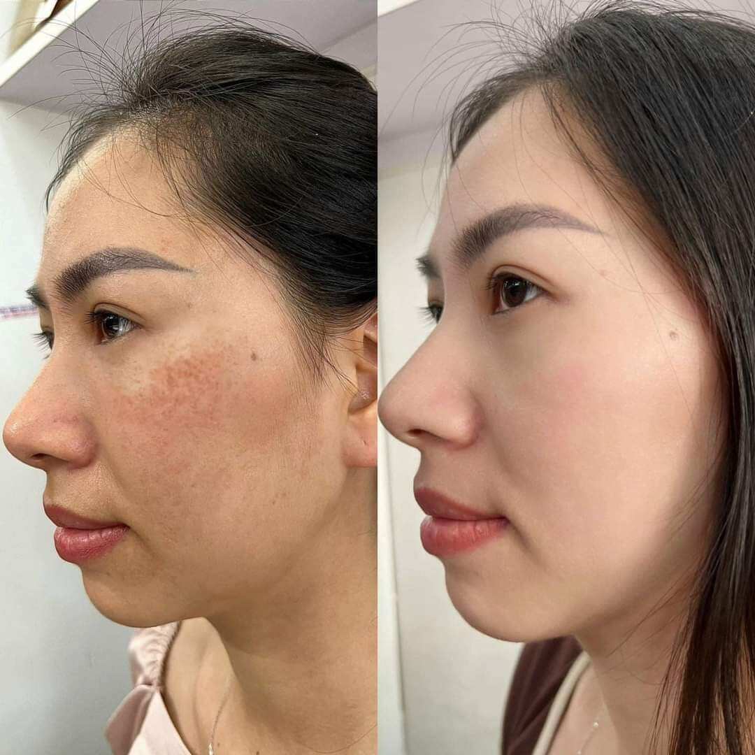 Serum Moose Giúp Trắng Da Mờ Nám,Cấp Ẩm,Tái Tạo Làn Da