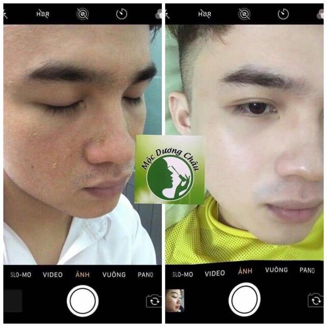 TÁI TẠO DA MỘC DƯƠNG CHÂU
