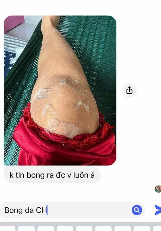 Body Bong Da CH Trắng Cấp Tốc Sau 7 Ngày