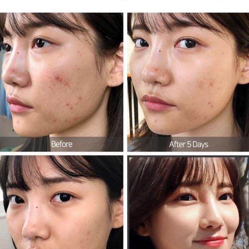 Chấm mụn Isoi Anci Doctor 14ml
