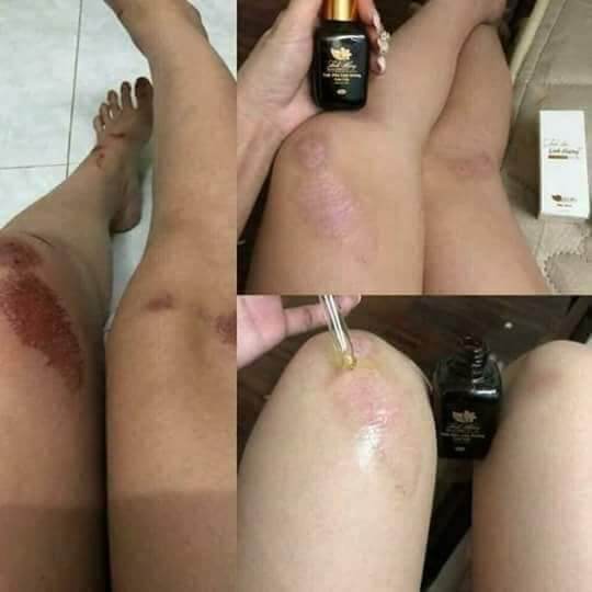 Tinh Dầu Cao Cấp Xoá Thâm Linh Hương