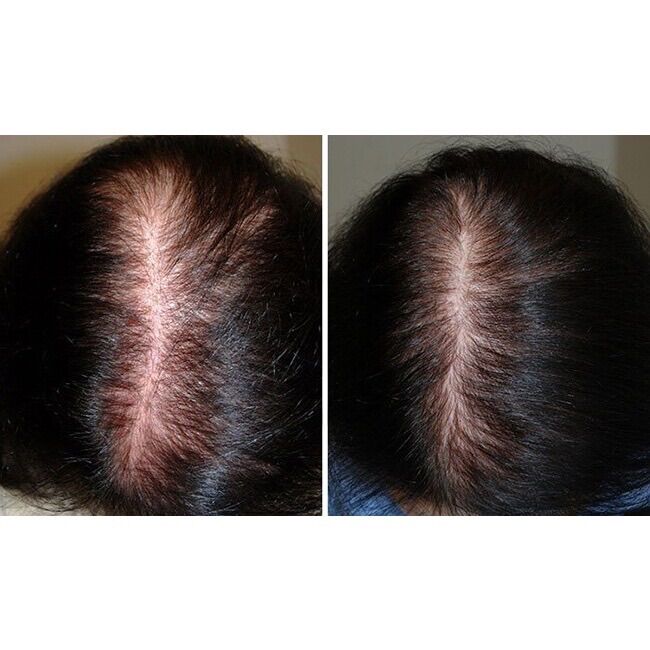 [PHÁP] Xịt Mọc Tóc Giảm Rụng Tóc Minoxidil Bailleul 2% Hộp 3x60ml