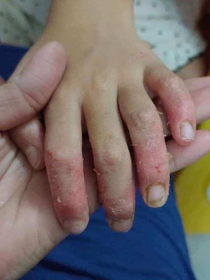 THẢO MỘC BÔI DA _ VIÊM DA DEN tkh