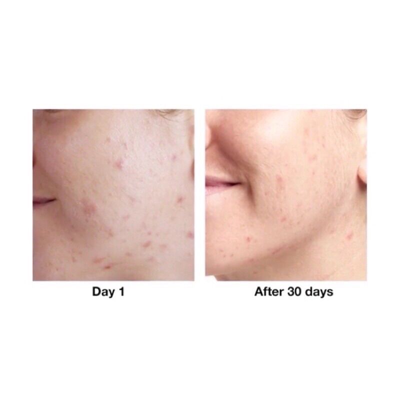 [Bill Canada] Gel chấm mụn Acne Solutions Clearing 15ml (tách set no box)