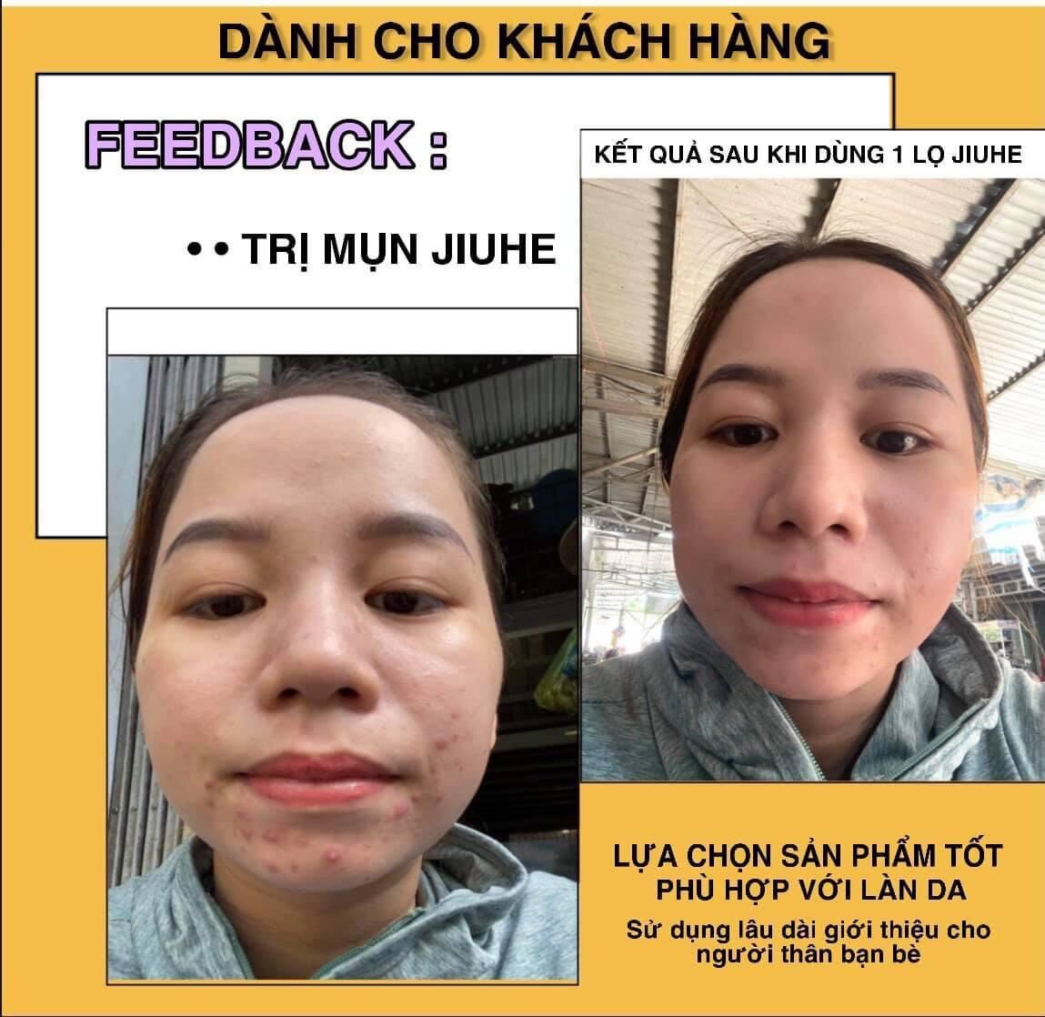 [HCM]COMBO KEM FACE JIUHE VÀ SERUM JIUHE MỤN ACNE EXTRA