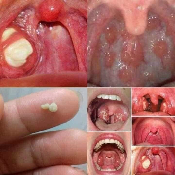 cao ho_ viêm họng ( họ nặng mấy cũng khỏi sau 3_7 ngày)