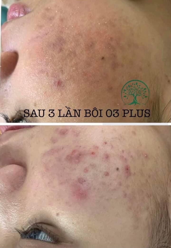 Combo cho da nám Bách y sâm ( nám 03 và cao trắng da)