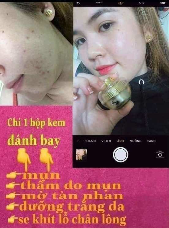 kem face chuyên mụn Huỳnh Đỗ