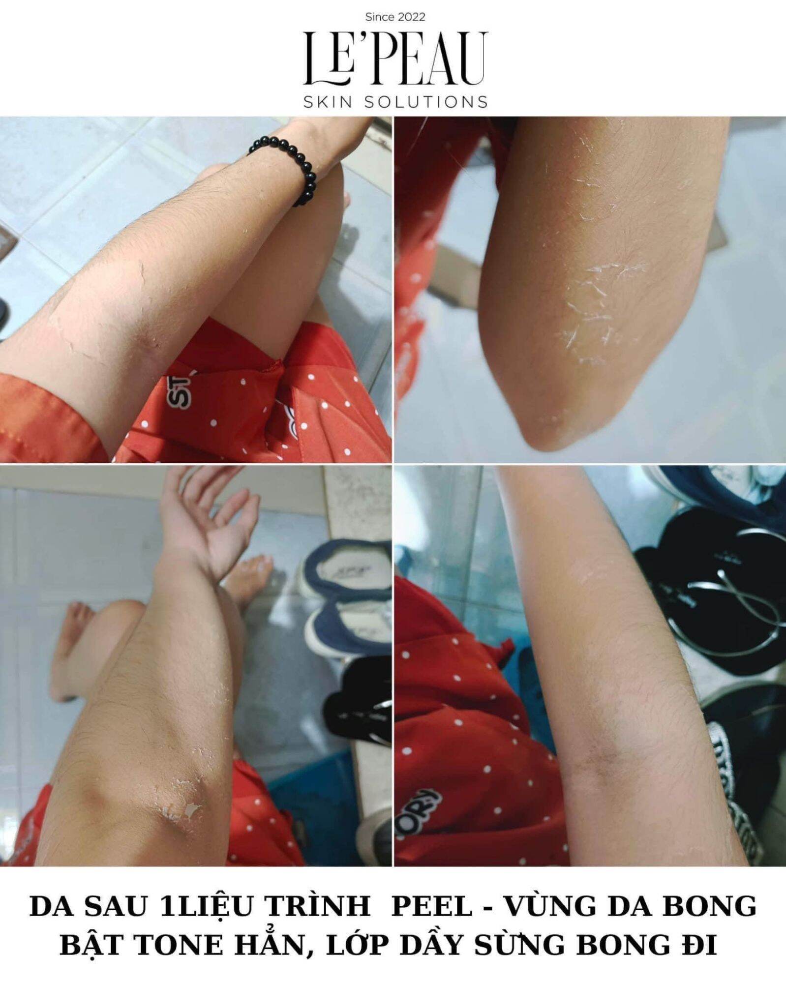 peel body,peel nach lepeau