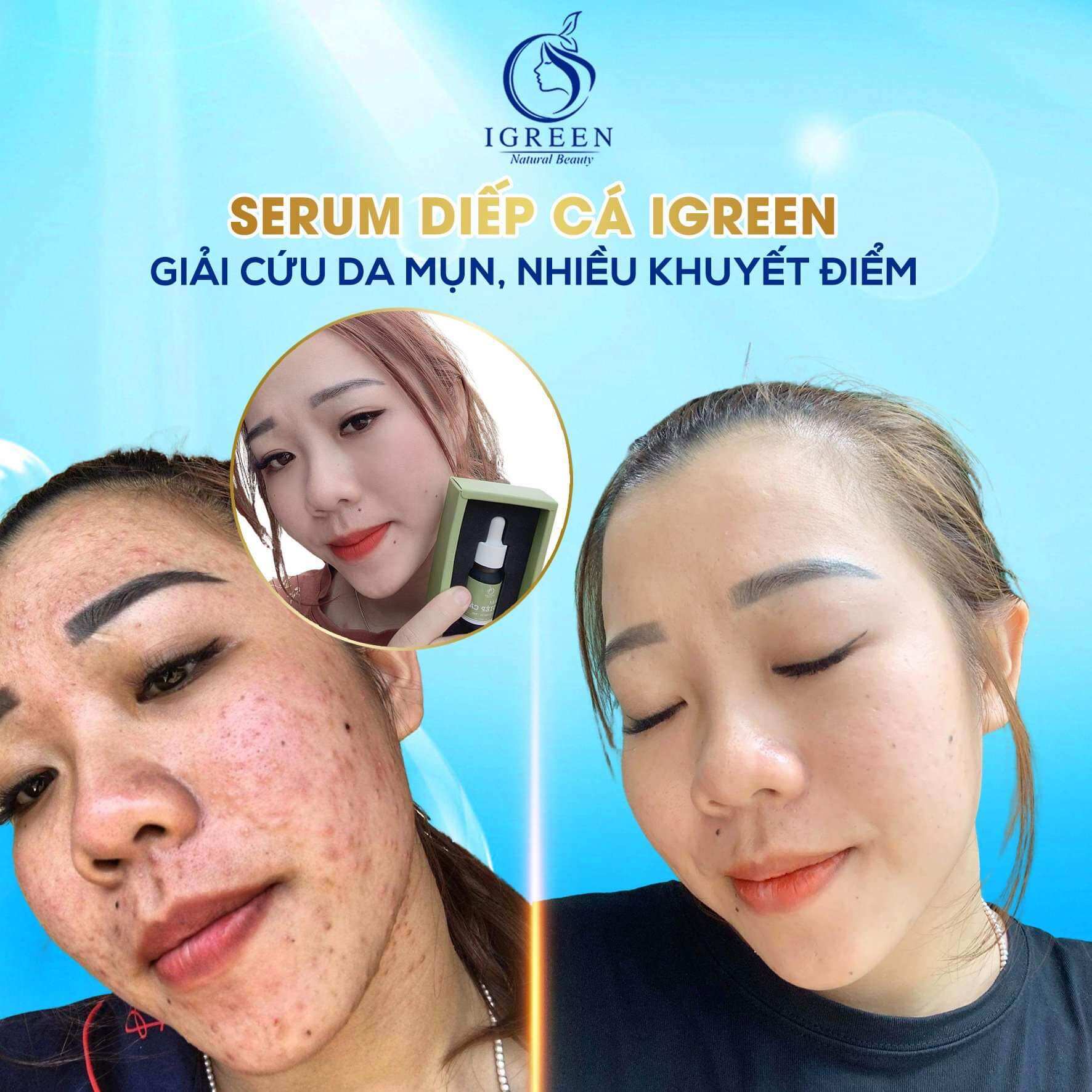 Combo Diếp Cá IGREEN (Sữa rửa mặt + Serum) – Sạch mụn, thâm