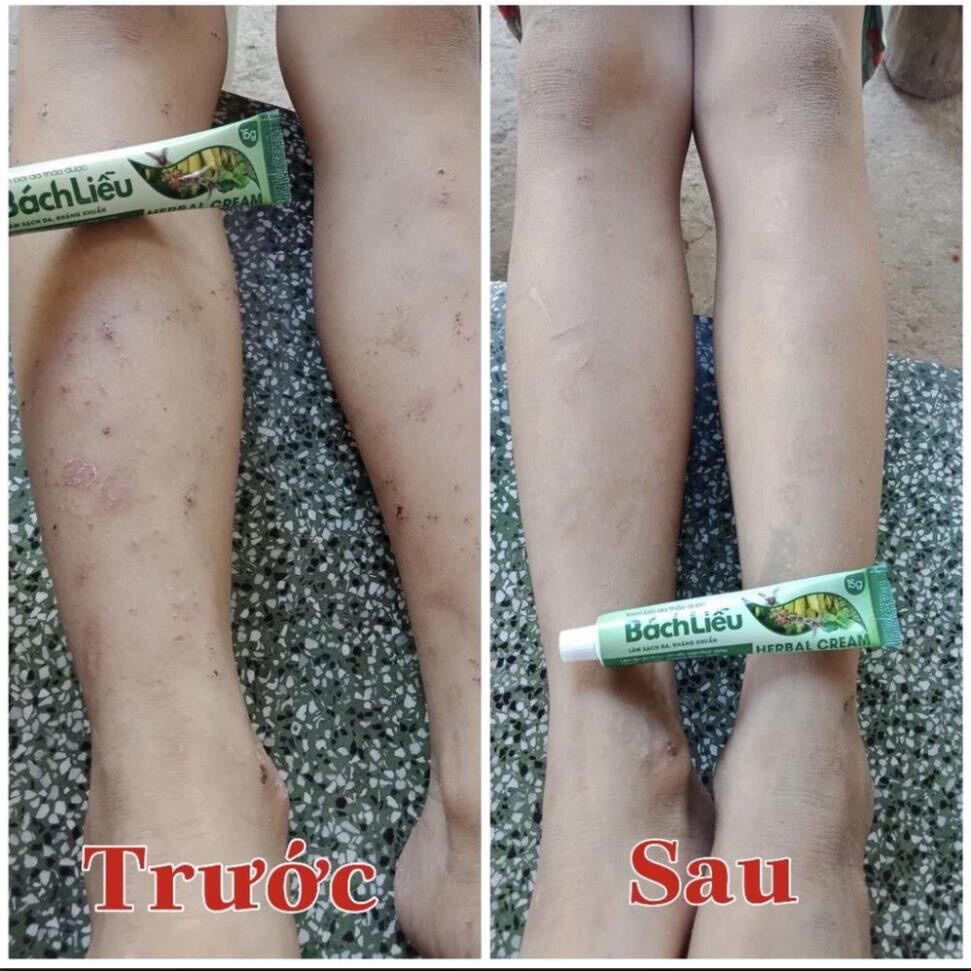 Kem bôi da thảo dược bách liễu
