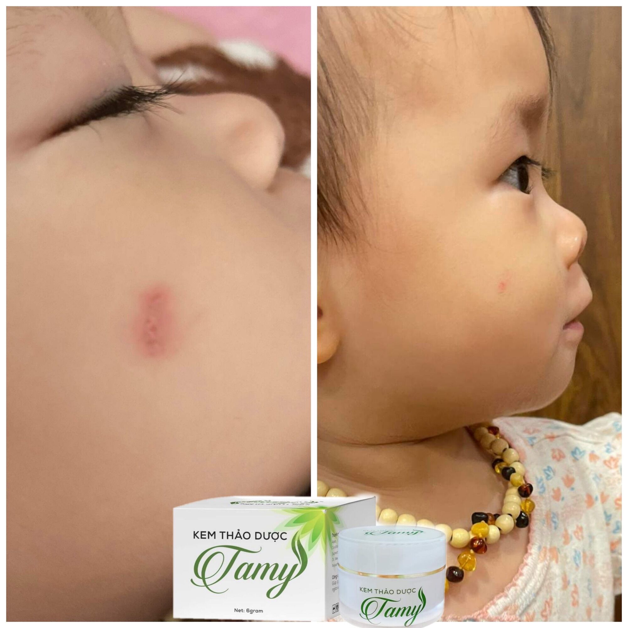 Kem thảo dược tamy bôi ngứa