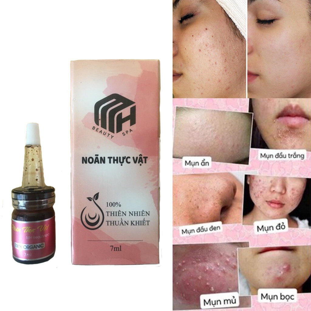 Noãn Thực Vật Sạch Mụn Mờ Thâm MH Beauty Spa ( Chính Hãng)