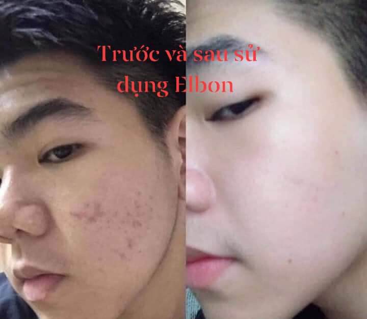 KEM MỤN,MỜ THÂM,TRẮNG DA