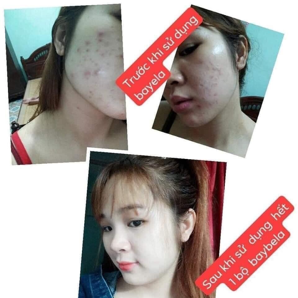 Kem mụn baybela ( hop số 5)