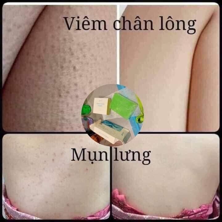 (MUA 1 tặng 1)🌿🌿SẠCH M.ỤN - MỜ THÂM – DƯỠNG DA TRẮNG HỒNG