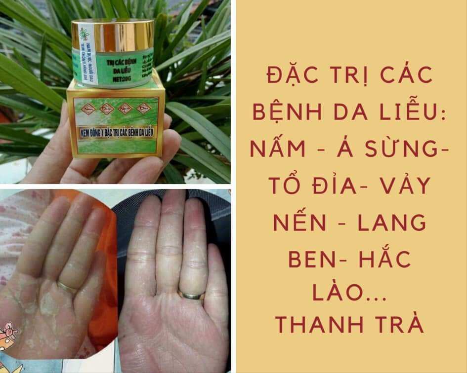 Kem Bôi Da Họ Chúc
