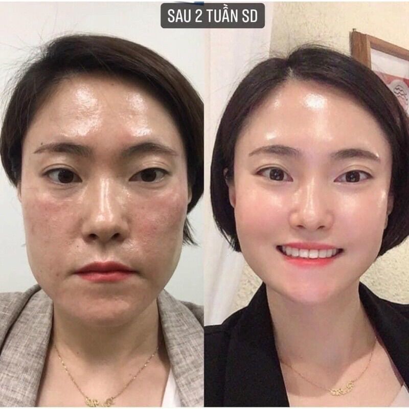 Serum cho da sạm nám Ekseption Hyaluronic