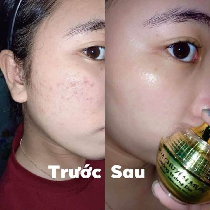 SỈ 2 HỘP FACE MỤN HUỲNH ĐỔ