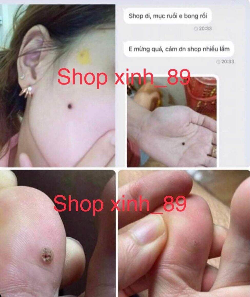 Kem tẩy nốt ruồi, mụn cóc, mụn thịt, mụn cơm, mắt cá handmade