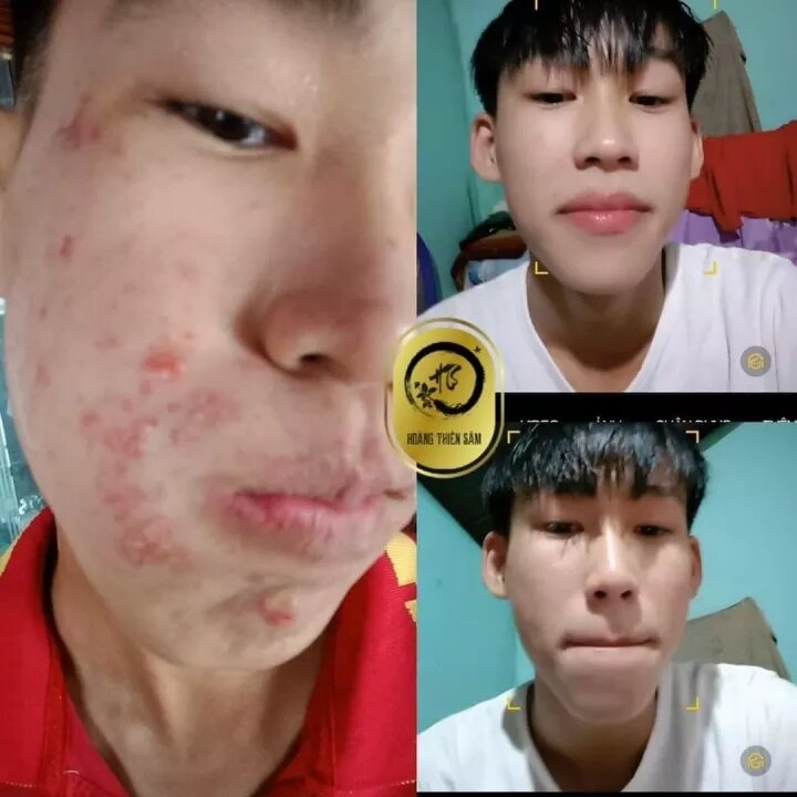 combo tinh chất Hoàng Thiên Sâm