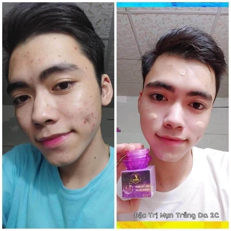 COMBO 2 HỘP KEM MỤN 2C MỸ PHẨM VIỆT