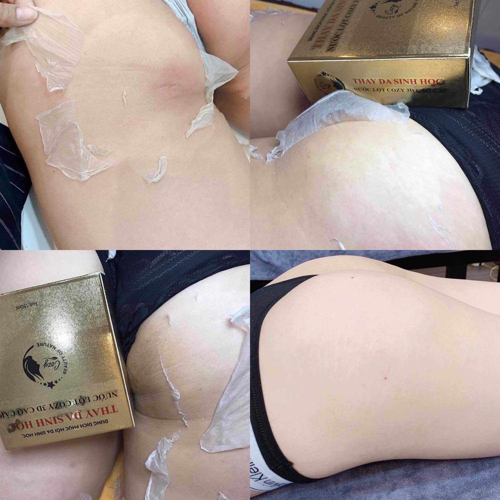 sét lột nách , mông , bẹn , cổ chỉ 20p