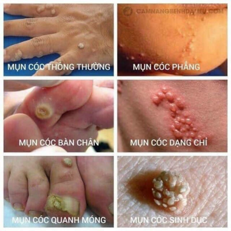 Chấm mụn cơm mụn cóc ConCon Thái Lan