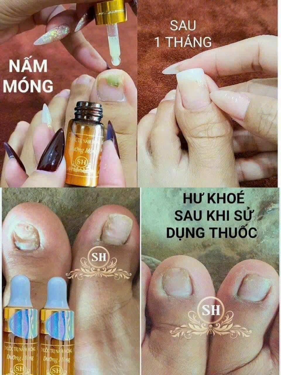 Nấm móng tay móng chân