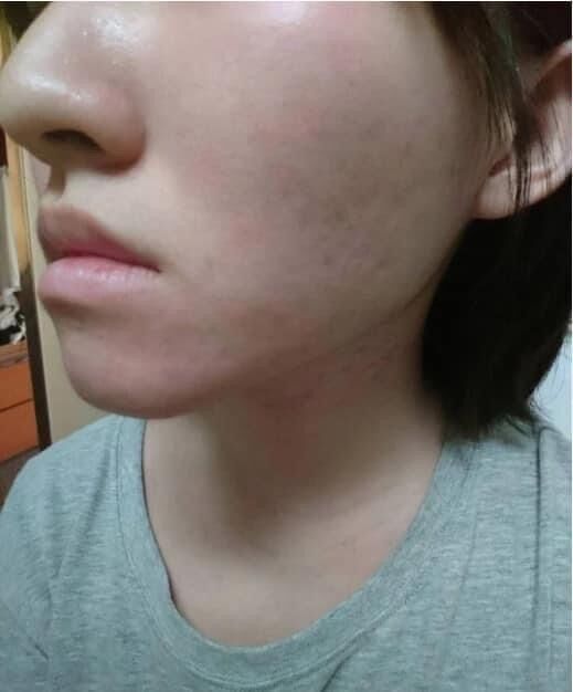 [HCM]SERUM JIUHE MỤN ACNE EXTRA THANH TÔ