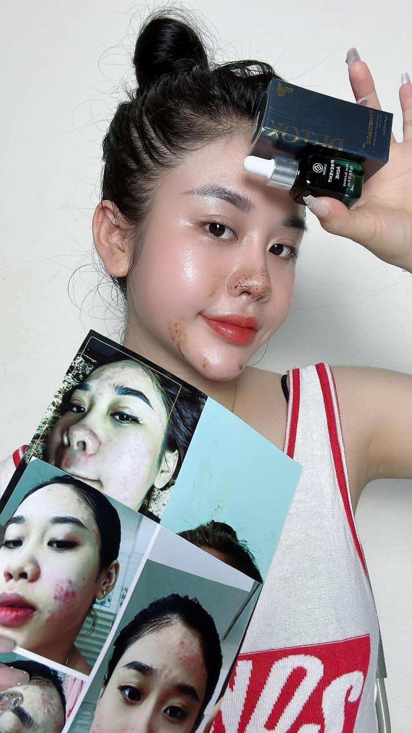 Serum mụn DETOX PREVENT ACNE