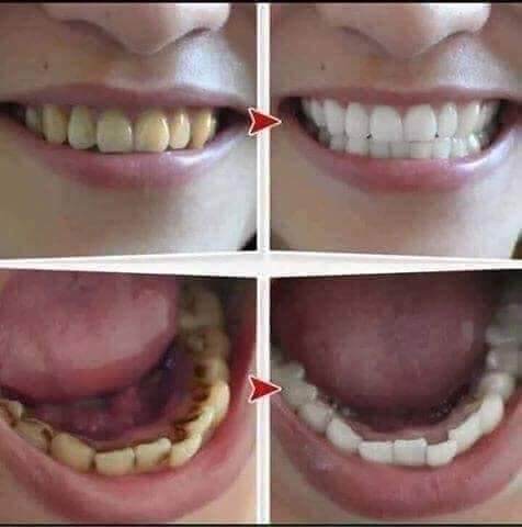 [HCM]THAN HOẠT TÍNH TRẮNG RĂNG MY SMILE