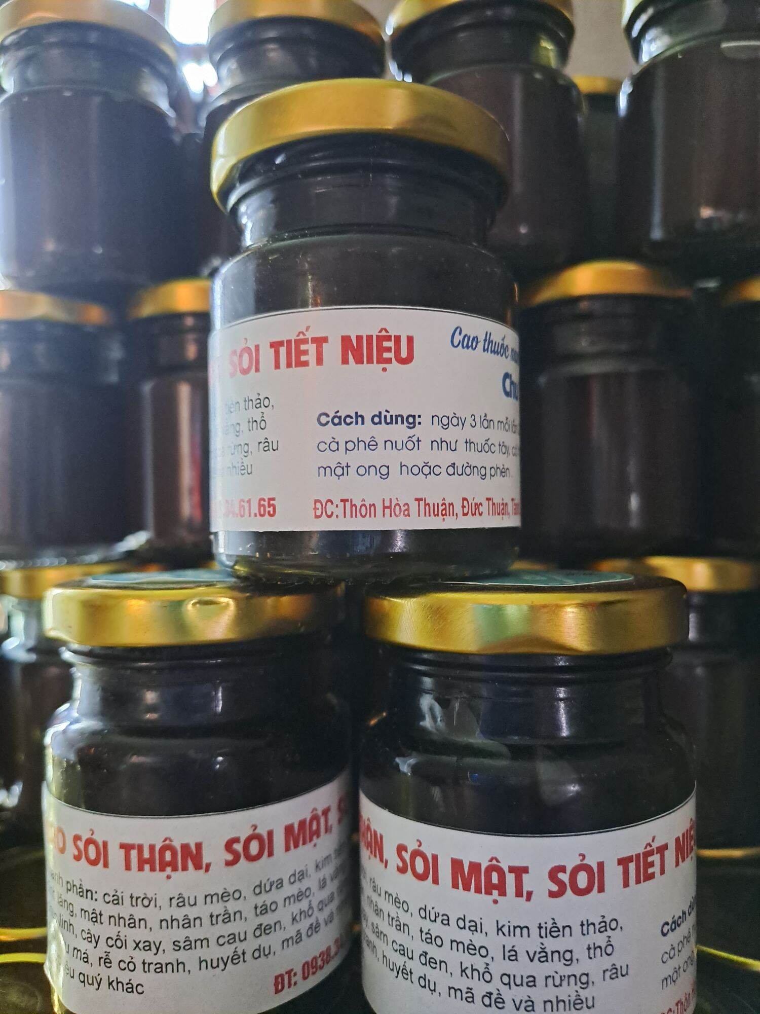 Cao sỏi thận , sỏi tiết niệu