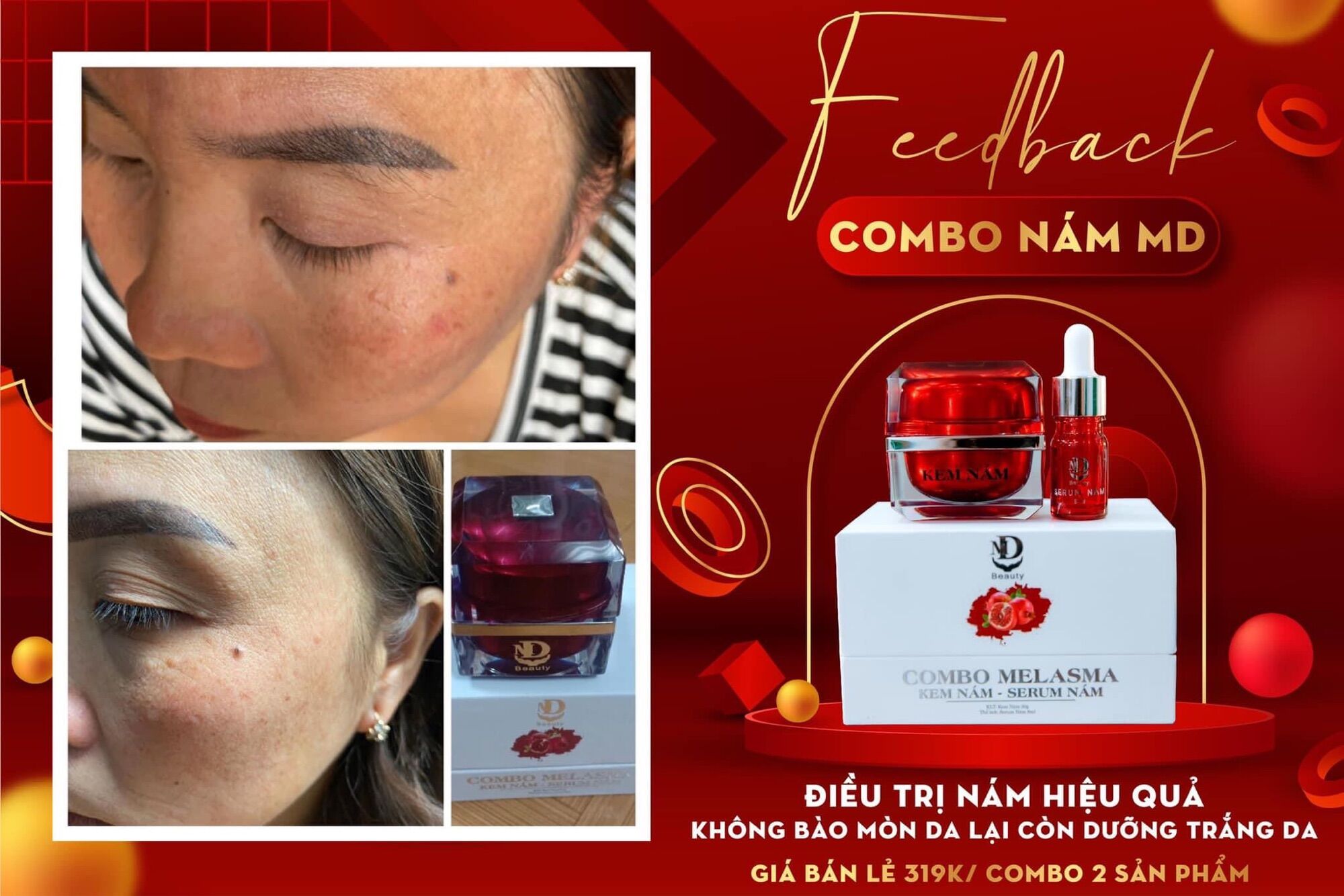 COMBO SỈ 10 HỌP KEM NÁM MD BEAUTY