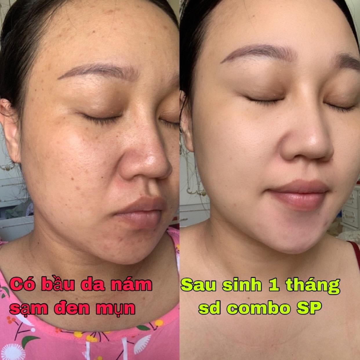 Bn White Combo Includes Face Cream + Serum