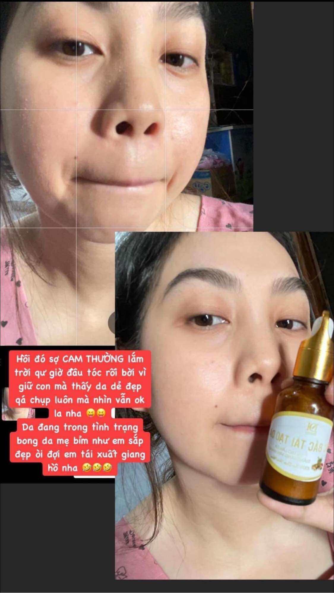 Thuốc bắc tái tạo da mụn